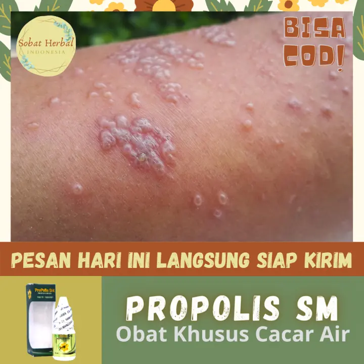 Propolis Sm Obat Tradisional Cacar Air Agar Mengering Obat Cacar Air Alami Paling Aman Obat Cacar