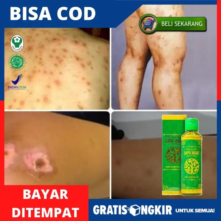 Obat Gatal Kulit Obat Kudis Obat Penghilang Bekas Budug Di Kaki Salep Menghilangkan Bekas Koreng Lama Obat Budug Penghilang Gudik Penghilang Bekas Koreng Di Kaki Tangan Kulit Obat Borok Dengan Minyak Sapu