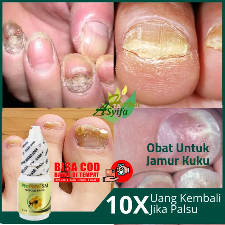 Obat Jamur Kuku Obat Infeksi Jamur Kuku Salep Jamur Kuku Di Tangan Dan Kaki Obat Kuku