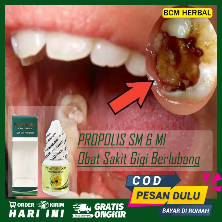 Obat Sakit Gigi Berlubang Gusi Bengkak Gigi Geraham Bawah Bikin Kepala Nyut Nyutan Sakit Dan Ngilu Parah Berdarah Bernanah Radang Di Sekitar Gigi Sariawan Propolis Sm Lazada Indonesia