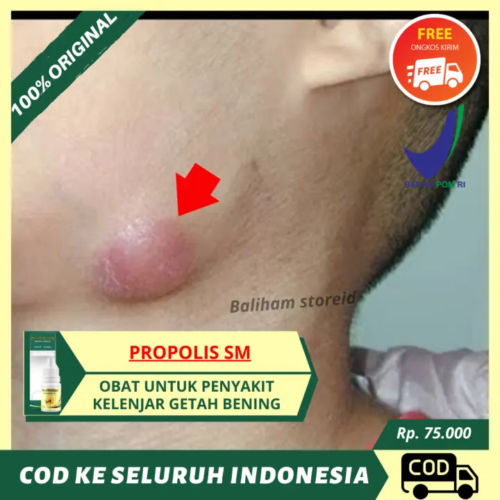 Obat Kelenjar Getah Bening Obat Limfoma Obat Pembengkakan Kelenjar Getah Bening Obat Bengkak Di Leher Obat Benjolan Di Leher Obat Kelenjar Getah Bening Yang Bengkak Obati Dengan Propolis Sm Brazilian Ori