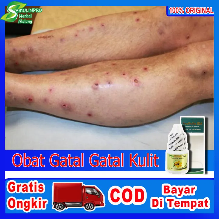 Propolis Sm Obat Gatal Gatal Jamur Kulit Eksim Herpes Panu Koreng Kudis Kurap Gudikan Budug Penghilang Bekas Luka Koreng Hitam Penghilang Koreng Kaki Koreng Di Kaki Obat Herbal Propolis Brazil Lazada