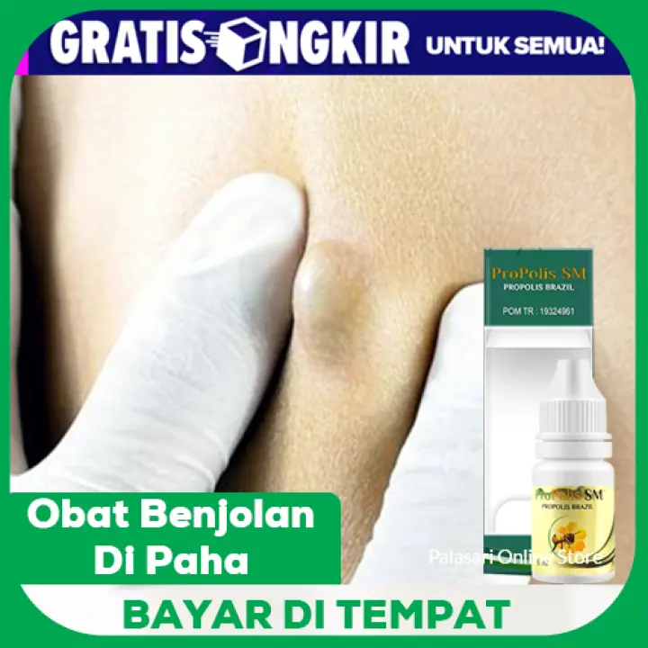 Obat Benjolan Di Paha Lipoma Benjolan Di Paha Kiri Benjolan Di Paha Kanan Benjolan Di Paha