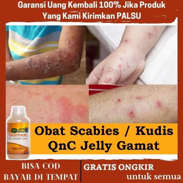 Obat Scabies Untuk Bayi Anak Dewasa Obat Scabies Untuk Manusia Cara Membunuh Kutu Scabies Dan Telurnya