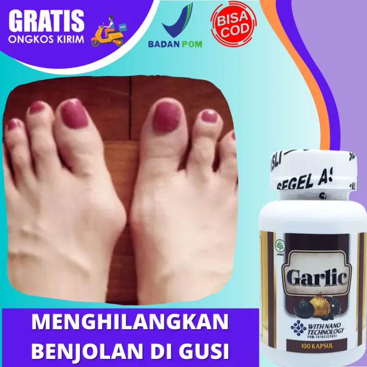 Obat Benjolan Di Kaki Menghilangkan Benjolan Pada Betis Kaki Sebelah Kiri Dan Kanan Paha Dekat Lutut