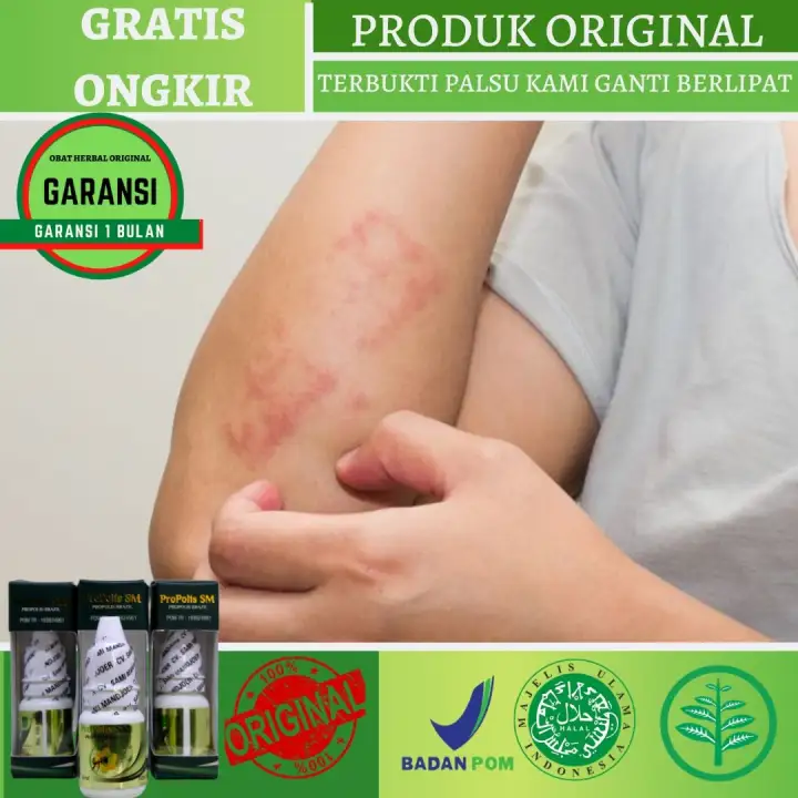 Obat Herbal Alami Cacar Air Api Koreng Korengan Di Kaki Di Tangan Di Kulit Borok Bernanah Ruam Merah Kurap Gatal Iritasi Obatnya Propolis Sm Brazil Dikirim Dari Bandung Lazada Indonesia