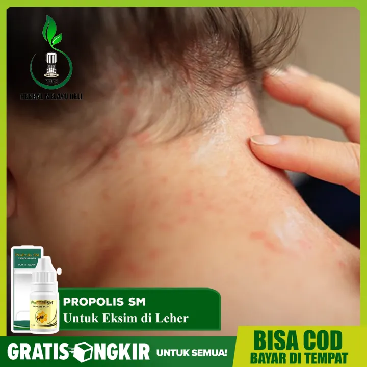Obat Herbal Eksim Di Leher Gatal Exsim Kulit Kering Bersisik Di Leher Propolis Sm Lazada Indonesia