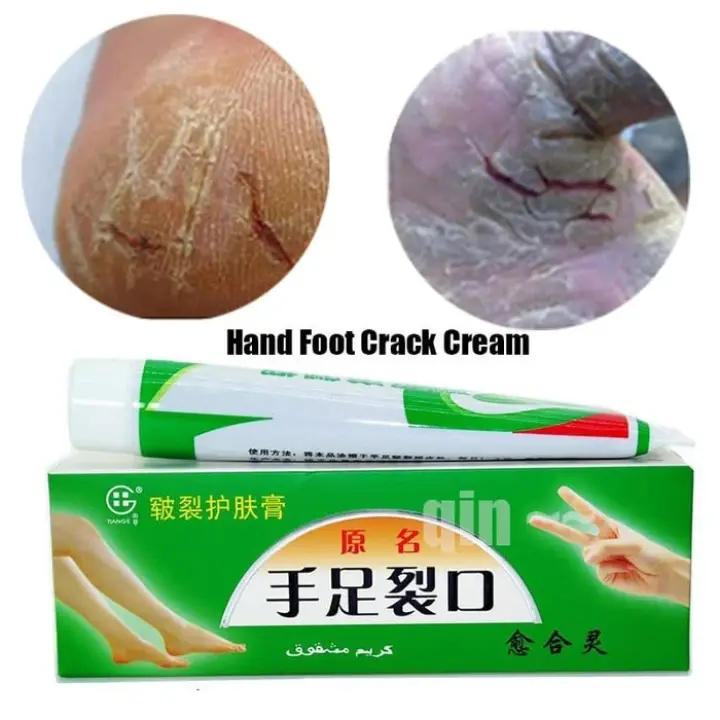Salep Obat Kulit Tangan Kaki Pecah Pecah Kulit Mengelupas Bekas Luka Lazada Indonesia