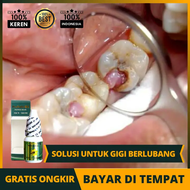Solusi Obat Gigi Berlubang Sakit Gigi Menahun Nyeri Gusi Bengkak Berdarah Keropos Koropos Penghilang Karang Gigi Bau Napas Hawa Propolis Sm Asli Tanpa Efek Samping Lazada Indonesia