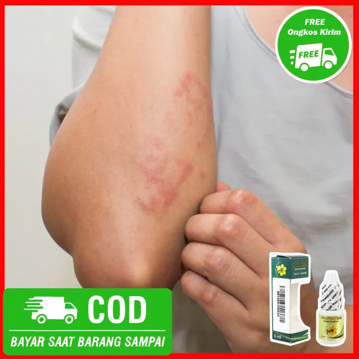 Obat Gatal Gatal Jamur Kulit Gatal Gatal Di Seluruh Badan Kulit Berbintik Bisul Bisul Bernanah Propolis Sm 100 Aman Tanpa Efek Samping Reni Renia Herbal Lazada Indonesia