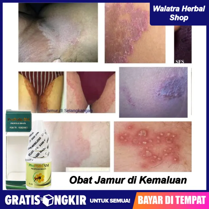 Obat Alami Infeksi Jamur Pada Miss V Gatal Di Sekitar Kemaluan Dan Selangkangan Propolis Sm Lazada Indonesia