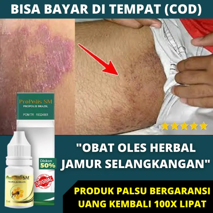 Obat Selangkangan Berjamur Obat Jamur Selangkangan Kurap Di Selangkangan Luka Ruam Gatal Babak Obat Selangkangan Hitam