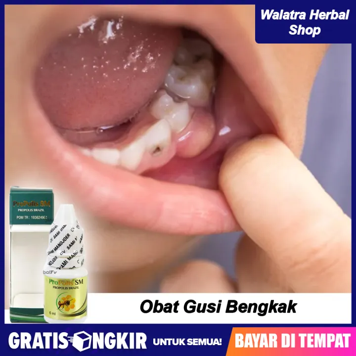 Obat Gusi Bengkak Sakit Gigi Nyeri Gusi Gusi Berdarah Benjolan Di Gusi Infeksi Gusi Radang Gusi