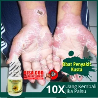 Jual Obat Kusta Lepra Terbaik  Lazada.co.id