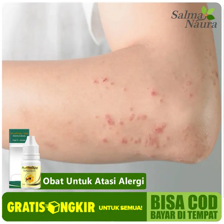 Obat Alergi Gatal Gatal Obat Ruam Kemerahan Pada Kulit Obat Gatal Pada Kulit Dengan Herbal Propolis Sm 100 Original Lazada Indonesia