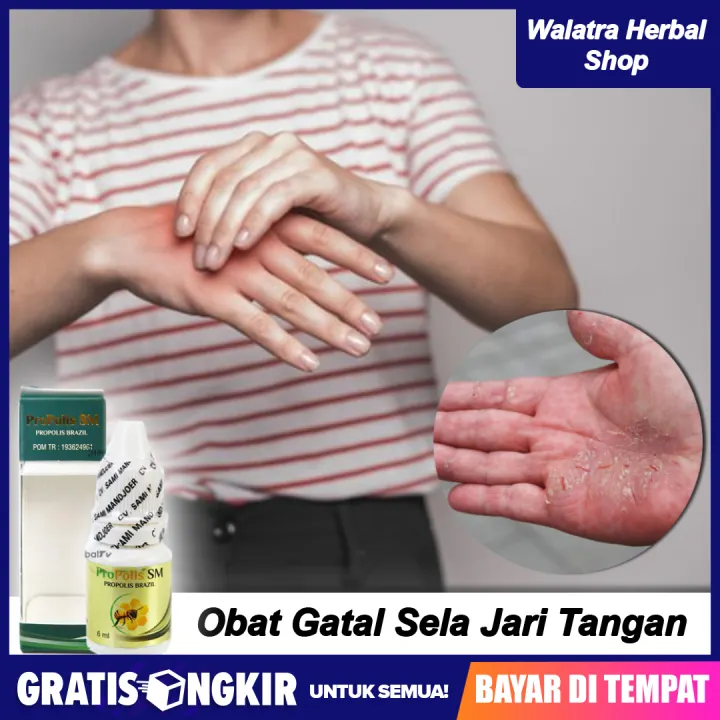 Obat Tradisional Gatal Pada Sela Jari Tangan Gatal Berair Gatal Bernanah Propolis Sm Lazada Indonesia