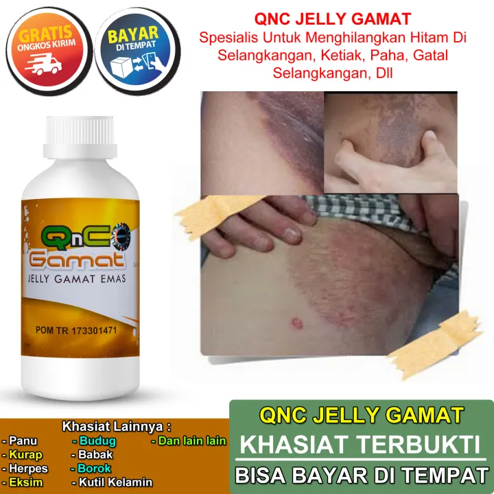Obat Untuk Menghilangkan Hitam Di Selangkangan Menghitam Ketiak Paha Gatal Selangkangan Gatel Eksim Kering Basah Herpes