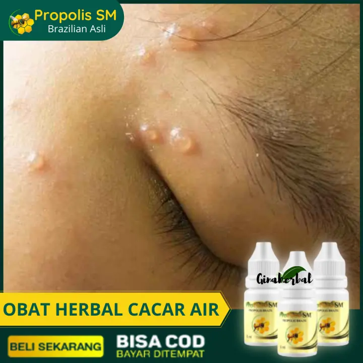 Obat Oles Cacar Air Diwajah Obat Alami Cacar Air Api Cacar Air Bernanah Obat Cacar Air