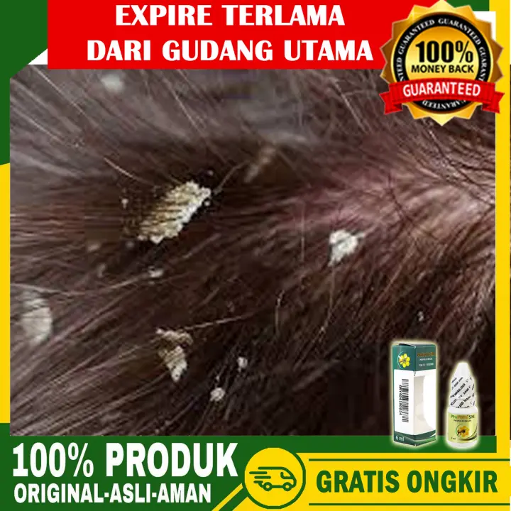 Propois Sm Obat Ketombe Kulit Kepala Gatal Kulit Kepala Berkerak Seperti Ketombe Kulit Kepala Bersisik Herbal