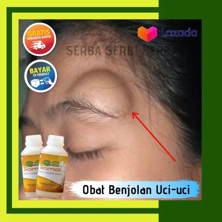 Obat Penghilang Benjolan Uci Uci Atas Alis Di Dahi Punggung Tangan Pergelangan Kaki Belakang Telinga Ketiak Alami 100 Jamu Berlegalitas Berkhasiat Kemasan 300 Ml Lazada Indonesia