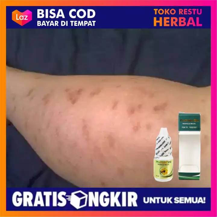 Penghilang Bekas Luka Koreng Salep Koreng Di Kaki Obat Koreng Di Kaki Salep Koreng Pemutih Kaki