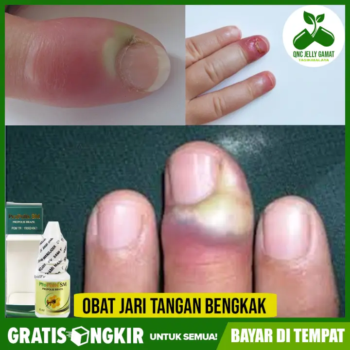 Obat Jari Tangan Bengkak Dan Bernanah Obat Jari Tangan Kering Dan Pecah Pecah Obat Jari Tangan Gatal Dan Bintik Bintik Berair Propolis Lazada Indonesia