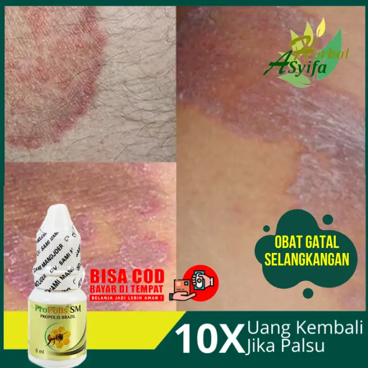 Obat Gatal Selangkangan Gatel Di Kemaluan Iritasi Kulit Gatal Jamur Di Lipatan Paha Ketiak Selangkangan Eksim Selangkangan Gatal Propolis Sm Lazada Indonesia Obat Gatal Selangkangan Gatel Di Kemaluan Iritasi Kulit Gatal Jamur Di Lipatan Paha Ketiak Selangkangan Eksim Selangkangan Gatal Propolis Sm Lazada Indonesia
