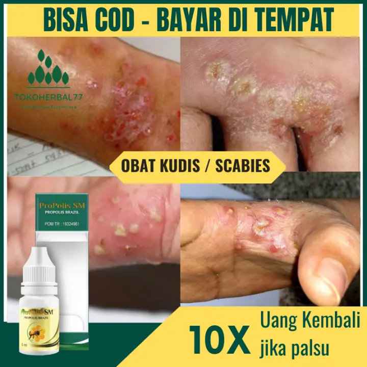 Obat Kudis Scabies Obat Kudis Di Kaki Kudis Di Kepala Kudis Di Tangan Obat Pembasmi