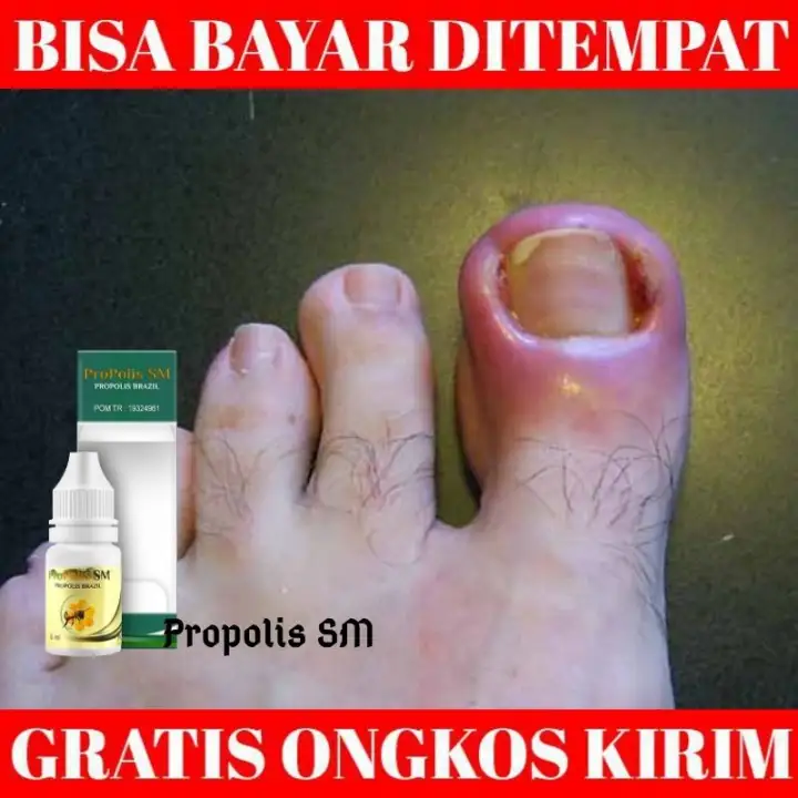 Obat Cantengan Cantengan Jempol Kaki Cantengan Tangan Cantengan Parah Cantengan Kaki Kuku Cantengan Dengan Herbal Propolis Sm Lazada Indonesia