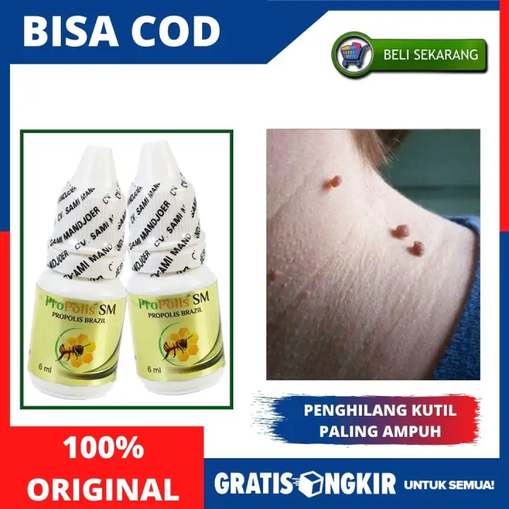 Obat Penghilang Kutil Kutil Di Leher Bahu Obat Alami Pengempis Kutil Kutilan Obat Buat Ngilangin Kutil