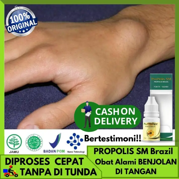 Obat Herbal Benjolan Ditangan Obat Benjolan Di Tangan Kiri Dan Kanan Obat Penghilang Daging Tumbuh Jadi