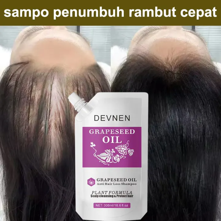 DEVNEN Shampo Anti Rambut Rontok Melembutkan & Menghaluskan Rambut Treatment Shampoo Oil Control Anti Ketombe Shampo Penumbuh Rambut