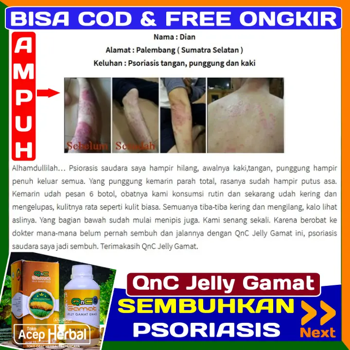 Obat Psoriasis Herbal Alami Qnc Jelly Gamat Obat Psoriasis Plak Psoriasis Kulit Kepala Psoriasis Inversi Gutata Psoriasis Pustular Psoriasis Eritrodermik Kulit Kering Bersisik Dan Gatal Obat Psoriasis Vulgaris Banyak Yang Sembuh