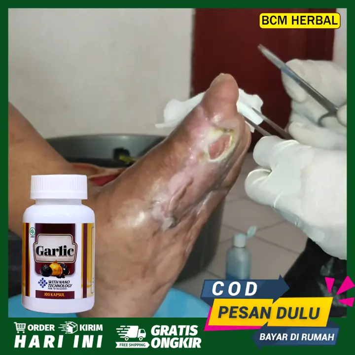 Obat Luka Bau Busuk Luka Diabetes Di Kaki Tangan Diabetes Basah Kering Gangren Gangrene Gas Susah Kering Susah Sembuh Bernanah Walatra Black Garlic Lazada Indonesia