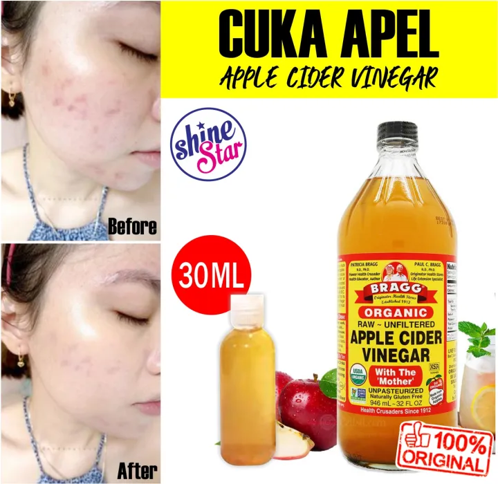 Shine Star Cuka Apel Untuk Wajah Bragg Apple Cider Vinegar Cuka Apel Original Murni Penghilang Jerawat Keriput Dan Flek Hitam Share In Jar 30ml Lazada Indonesia