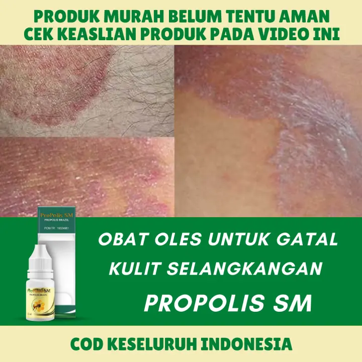 Propolis Sm Solusi Alami Untuk Kulit Kulit Selangkangan Lecet Obat Gatal Dan Ruam Selangkangan Jamur Di