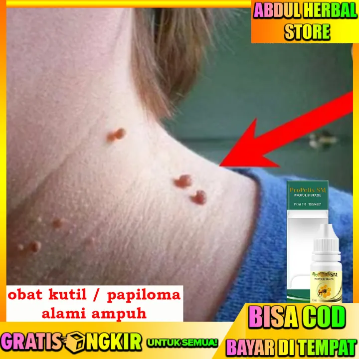 Obat Kutil Pengempis Kutil Di Leher Di Tangan Di Tubuh Di Kaki Perontok Kutil Obat Penghilang