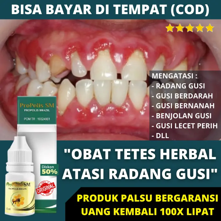 Obat Peradangan Gusi Berdarah Dan Bernanah Obat Radang Gusi Obat Sakit Gusi Berdarah Bernanah Gusi Bengkak Besar Merah Gusi Turun Radang Gusi Abses Gusi Benjolan Di Gusi Lecet Perih Bolong Berlubang