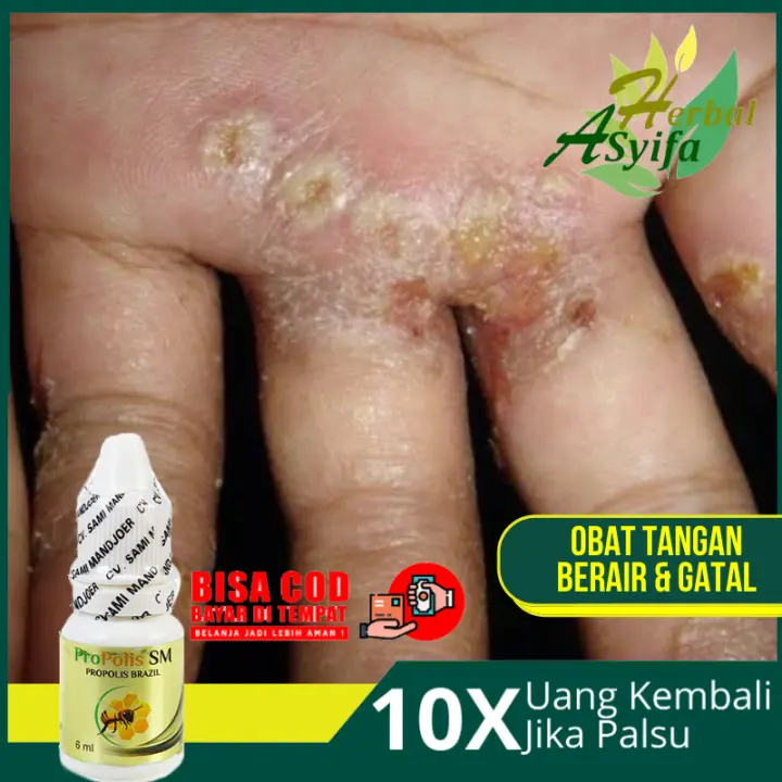 Obat Tangan Berair Dan Gatal Budug Kudis Scabies Cenang Dishidrosis Eksim Penghilang Budug Di Kaki Dan Tangan Obat Oles Budug Alami Salep Budug Bernanah Gatal Tradisional Propolis Brazil Sm Lazada Indonesia