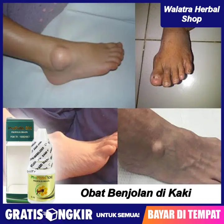 Obat Benjolan Di Kaki Jari Kaki Telapak Kaki Pergelangan Kaki Propolis Sm Lazada Indonesia