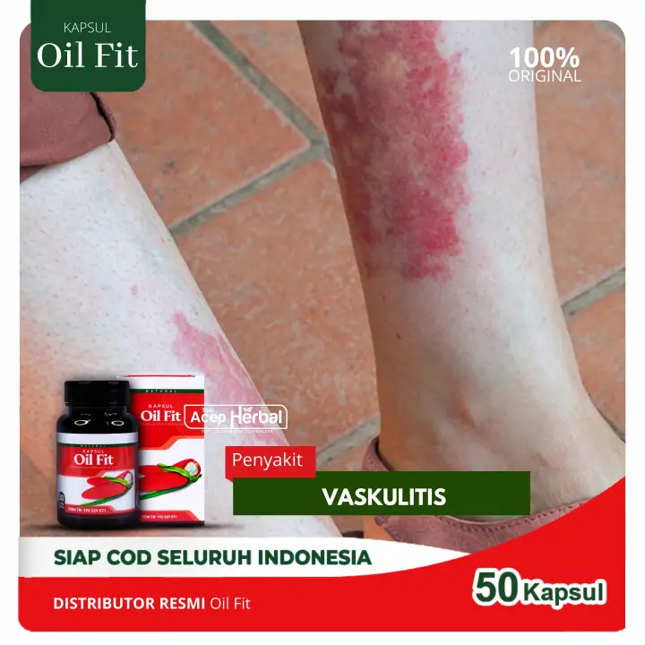 Obat Vaskulitis Obat Radang Pembuluh Darah Peradangan Pembuluh Darah Oilfit 50 Kapsul Acep Herbal Official Multikhasiat 100 Minyak Buah Merah Papua Asli Kualitas Premium Lazada Indonesia