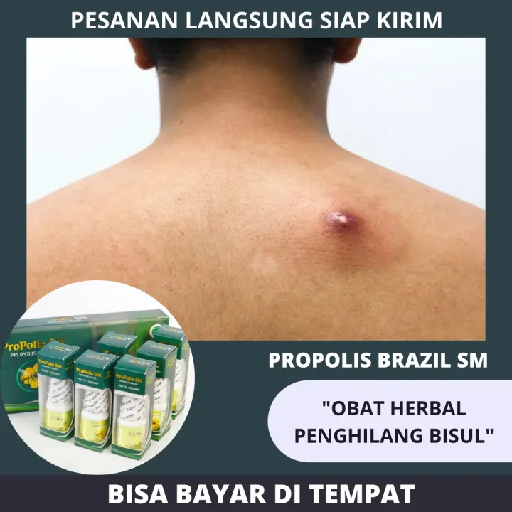 Ketahui Penyebab Bisul Pada Anak Dan Cara Mengatasinya Orami