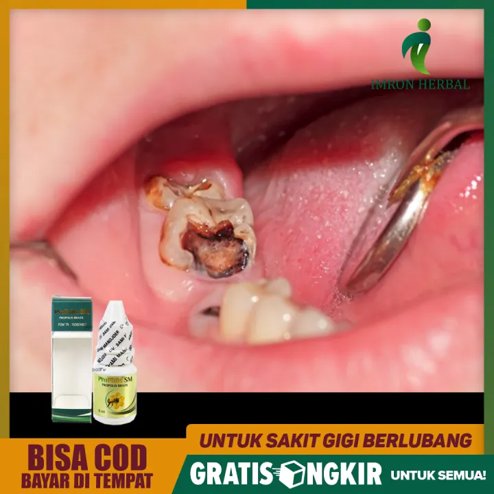 Obat Sakit Gigi Berlubang Untuk Anak 3 4 5 Tahun Propolis Sm Lazada Indonesia