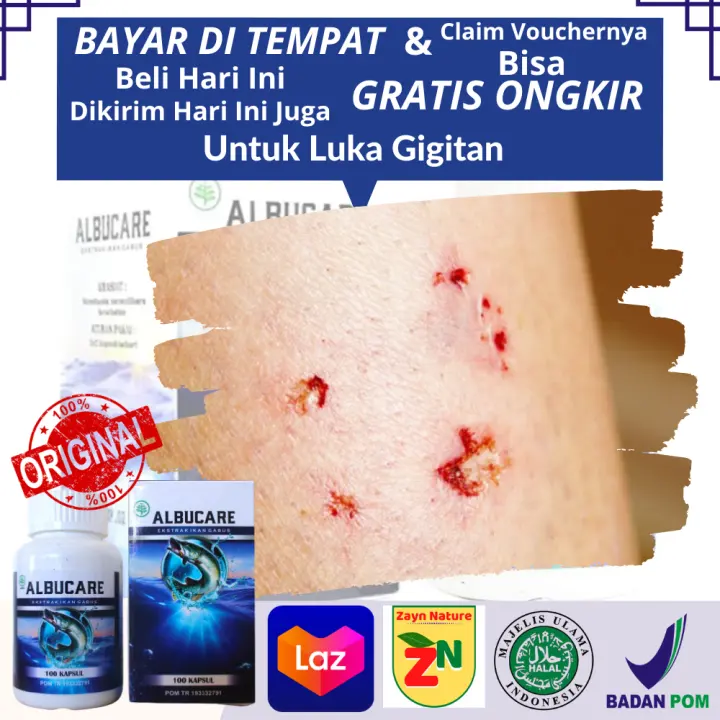 Obat Luka Gigitan, Obat Herbal Untuk Mengobati Luka Gigitan Hewan  Bertaring, Suplemen Penghilang Bekas Gigitan Anjing Kucing Di Pergelangan  Tangan 