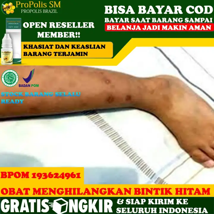 Obat Bintik Bintik Paha Menghilangkan Bintik Hitam Paha Menghilangkan Bekas Bintik Paha Gatal Paha Gatel Selangkangan Jamur Selangkangan Bentol Paha Biduran Kaligata Gatal Gatal Pemutih Selangkangan Propolis Sm Brazil Lazada Indonesia Obat Bintik Bintik Paha Menghilangkan Bintik Hitam Paha Menghilangkan Bekas Bintik Paha Gatal Paha Gatel Selangkangan Jamur Selangkangan Bentol Paha Biduran Kaligata Gatal Gatal Pemutih Selangkangan Propolis Sm Brazil Lazada Indonesia