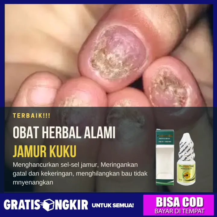 Obat Jamur Kuku Obat Infeksi Jamur Kuku Obat Kuku Yang Rusak Penghilang Jamur Kuku Kuku Tangan