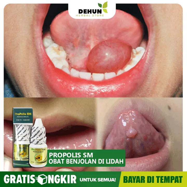 7 Penyebab Benjolan Di Lidah Yang Perlu Anda Ketahui Hello Sehat