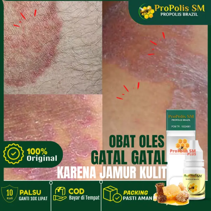 Cara Menghilangkan Kurap Sampai Ke Akar Kadas Kurap Yang Sudah Lama Obat Kurap Yang Paling Infeksi
