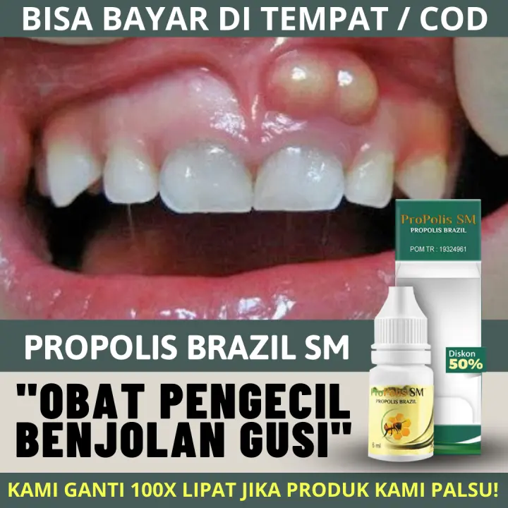 Obat Pengecil Benjolan Di Gusi Anak Dan Dewasa Obat Benjolan Gusi Polip Gigi Radang Gusi Berdarah