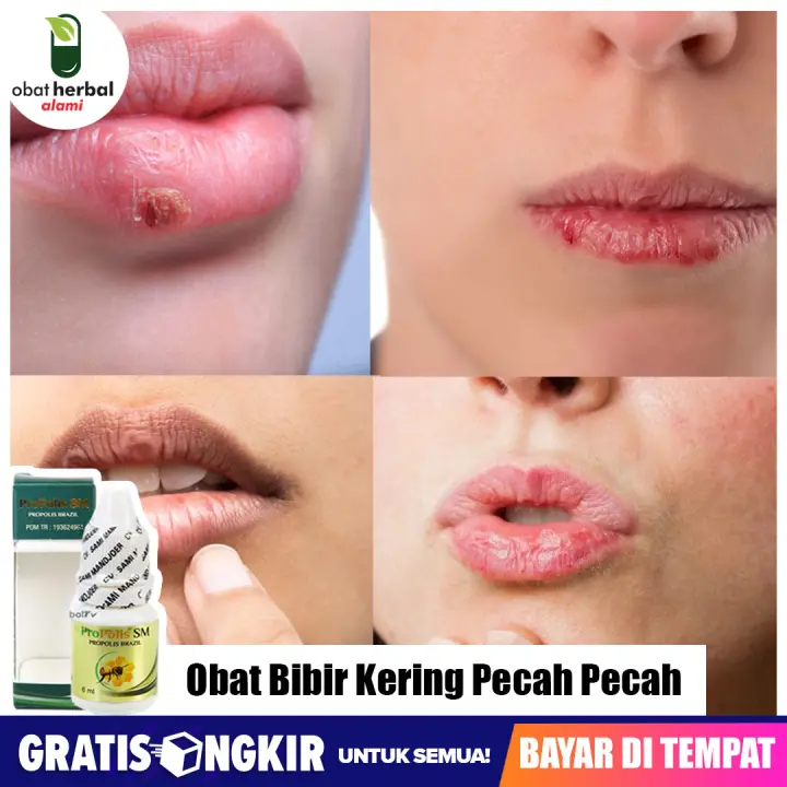 Obat Bibir Kering Pecah Pecah Anak Dan Dewasa Bibir Pecah2 Propolis Sm Lazada Indonesia